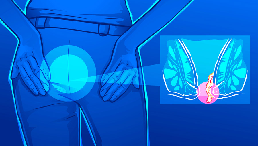 Basur Nedir ? Hemoroid Nedir ?