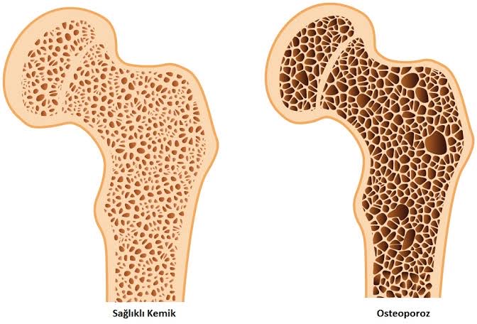 Osteoporoz Nedir ? Nasıl Önlenir ?