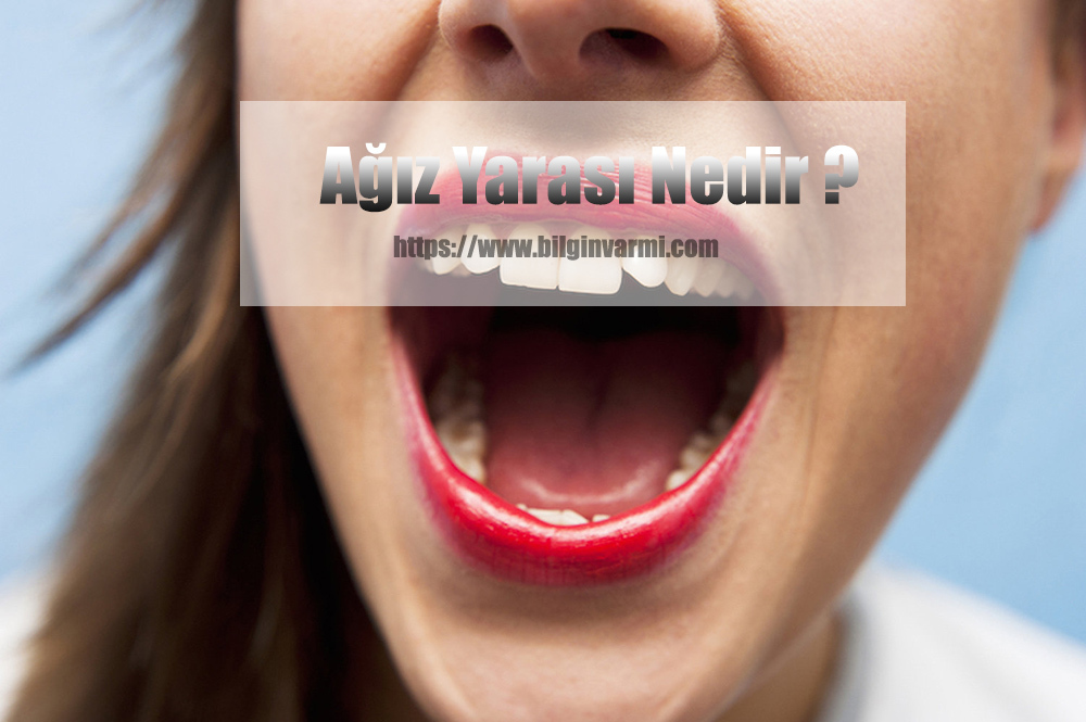 Ağız Yarası Nedir ? Ağız Yarasına Ne İyi Gelir ? Bilgin Var mı