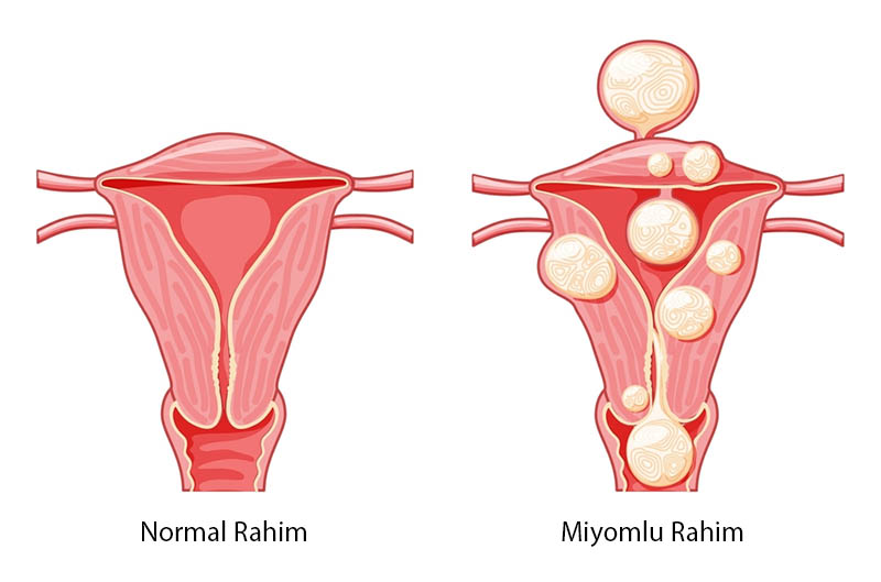 Es peligroso un pólipo endometrial