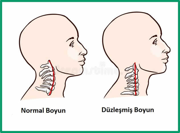 Boyun Düzleşmesi Nedir ? Nasıl Anlaşılır ?